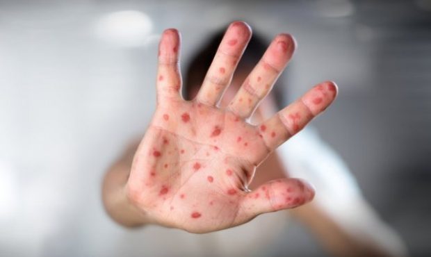 افزایش موارد سرخک در کشور در سال جاری/ موارد جدید از افغانستان و پاکستان وارد ایران شده اند